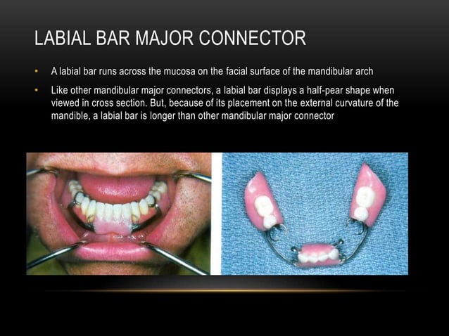 MAJOR CONNECTORS AND MINOR CONNECTORS IN RPD - Dr Prathibha Prasad ...