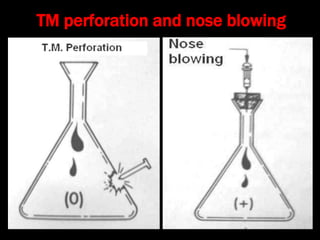 TM perforation and nose blowing
 