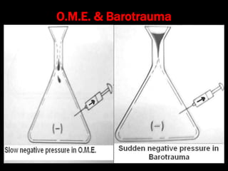 O.M.E. & Barotrauma
 