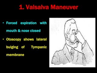 1. Valsalva Maneuver
• Forced expiration with
mouth & nose closed
• Otoscopy shows lateral
bulging of Tympanic
membrane
 
