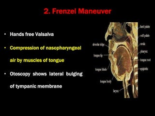 2. Frenzel Maneuver
• Hands free Valsalva
• Compression of nasopharyngeal
air by muscles of tongue
• Otoscopy shows lateral bulging
of tympanic membrane
 