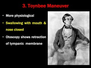 3. Toynbee Maneuver
• More physiological
• Swallowing with mouth &
nose closed
• Otoscopy shows retraction
of tympanic membrane
 