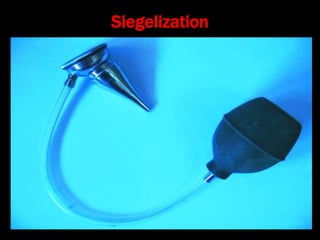Siegelization
 
