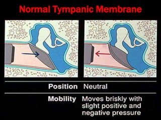 Normal Tympanic Membrane
 