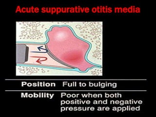 Acute suppurative otitis media
 