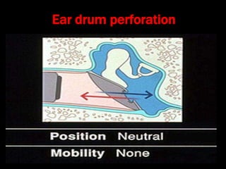 Ear drum perforation
 