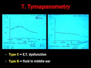 7. Tymapanometry
• Type C = E.T. dysfunction
• Type B = fluid in middle ear
 