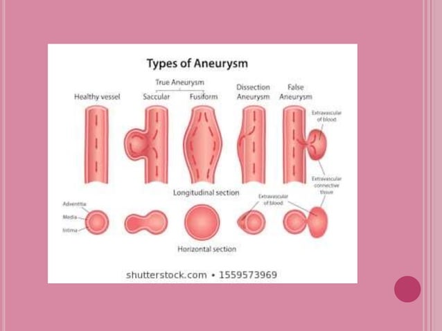 VASCULAR DISORDER - Anuerysm | PPT