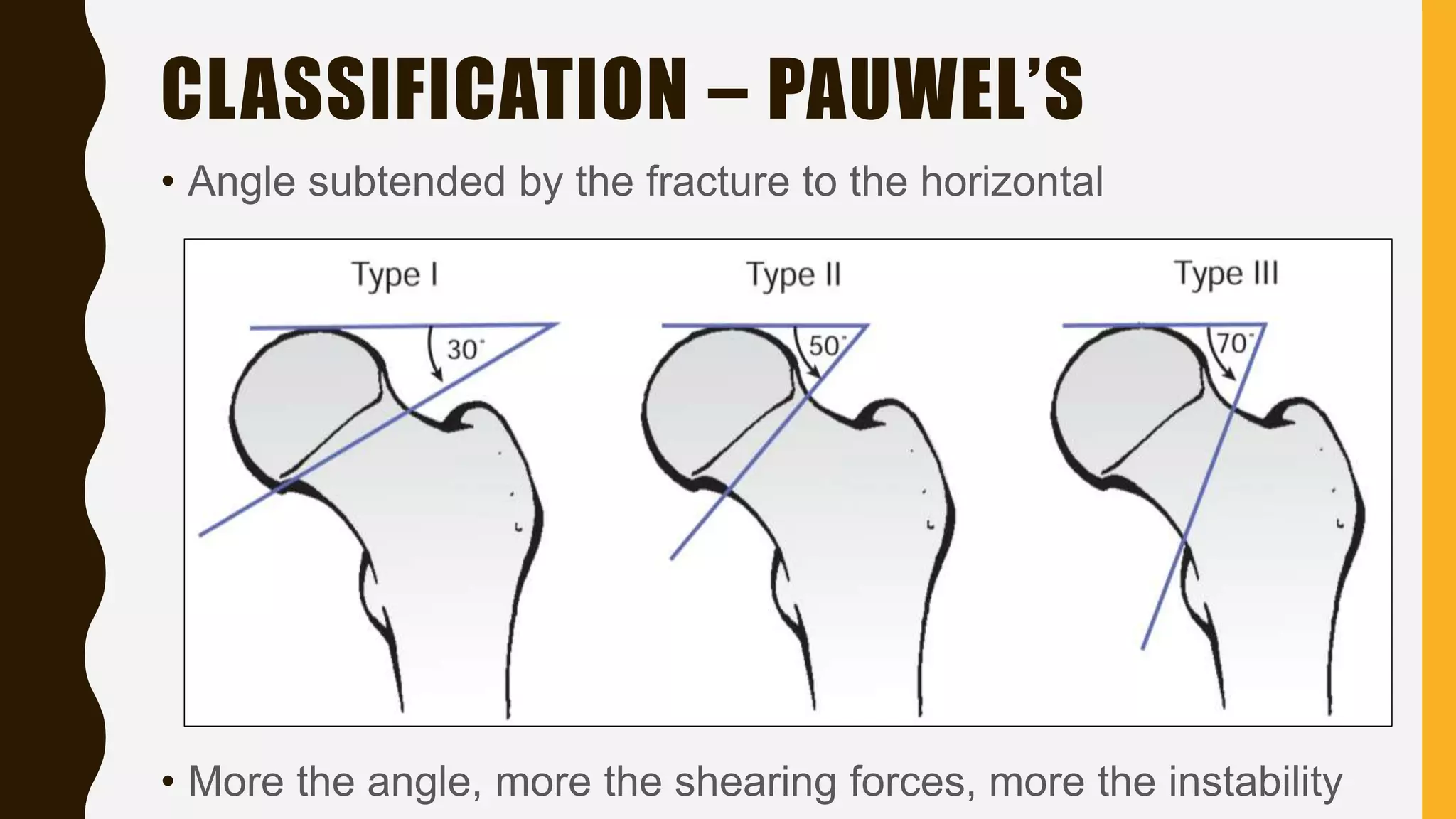 CLASSIFICATION – PAUWEL’S
• Angle subtended by the fracture to the horizontal
• More the angle, more the shearing forces, more the instability
 