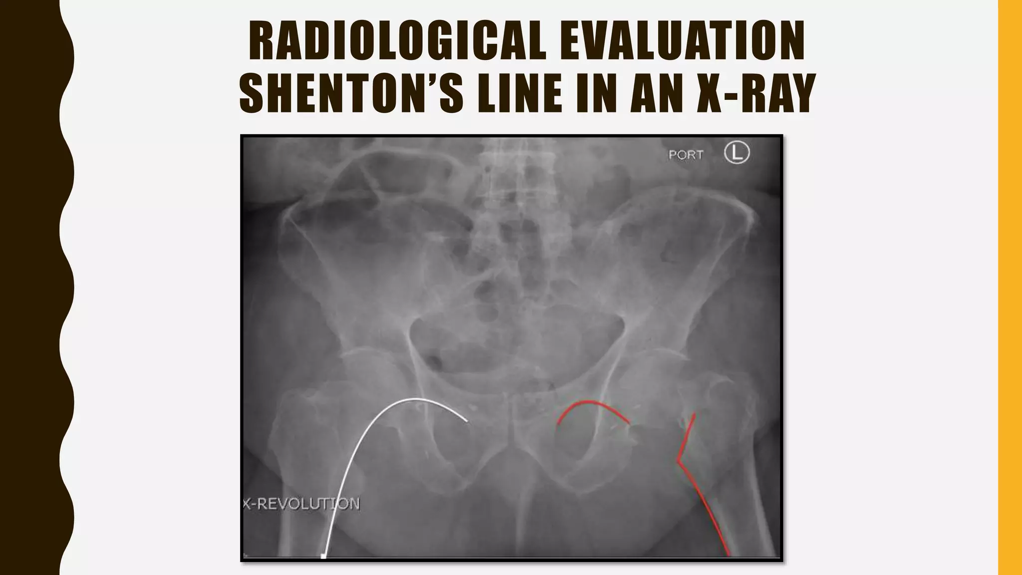 RADIOLOGICAL EVALUATION
SHENTON’S LINE IN AN X-RAY
 