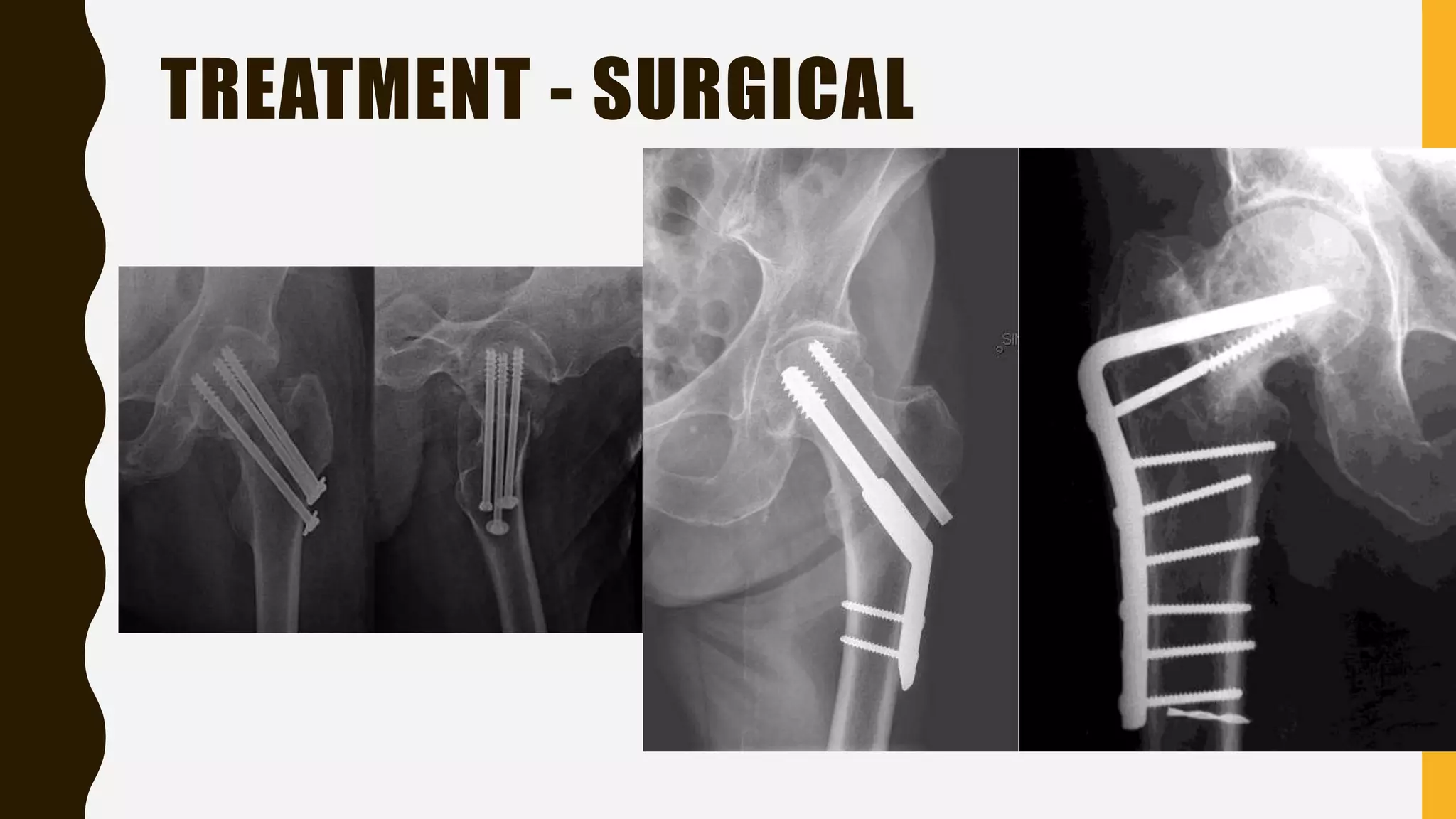 TREATMENT - SURGICAL
 