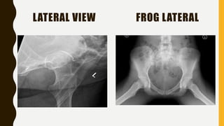 Fracture neck of femur | PPTX