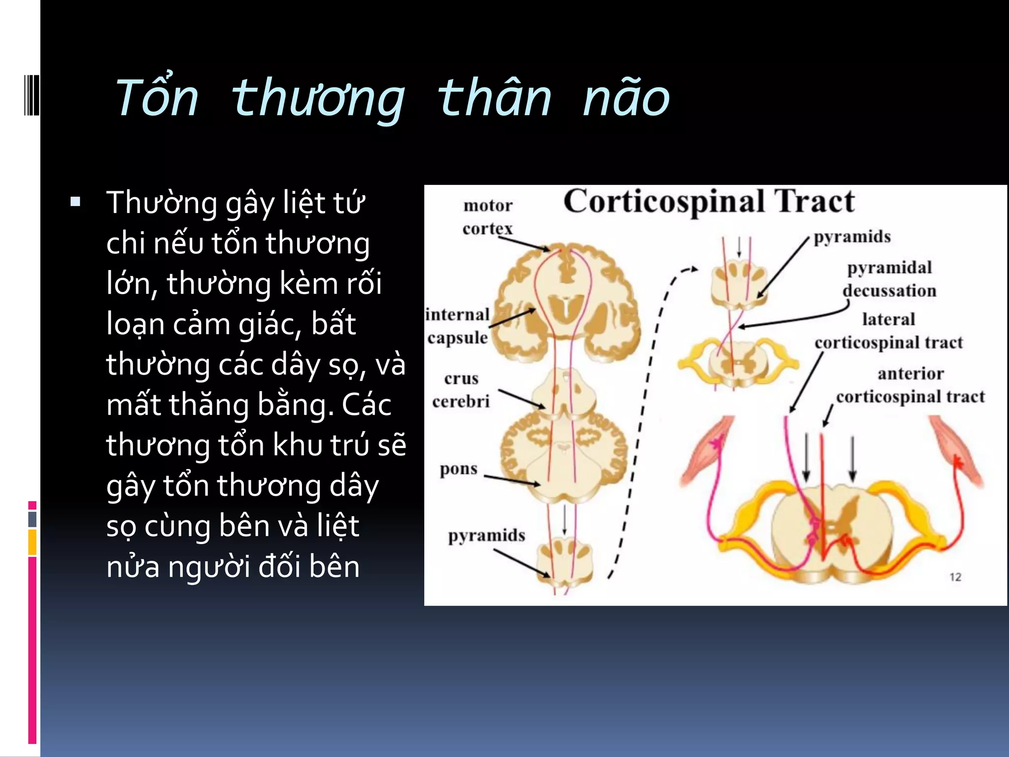 Tổn thương thân não
▪ Thường gây liệt tứ
chi nếu tổn thương
lớn, thường kèm rối
loạn cảm giác, bất
thường các dây sọ, và
mất thăng bằng. Các
thương tổn khu trú sẽ
gây tổn thương dây
sọ cùng bên và liệt
nửa người đối bên
 