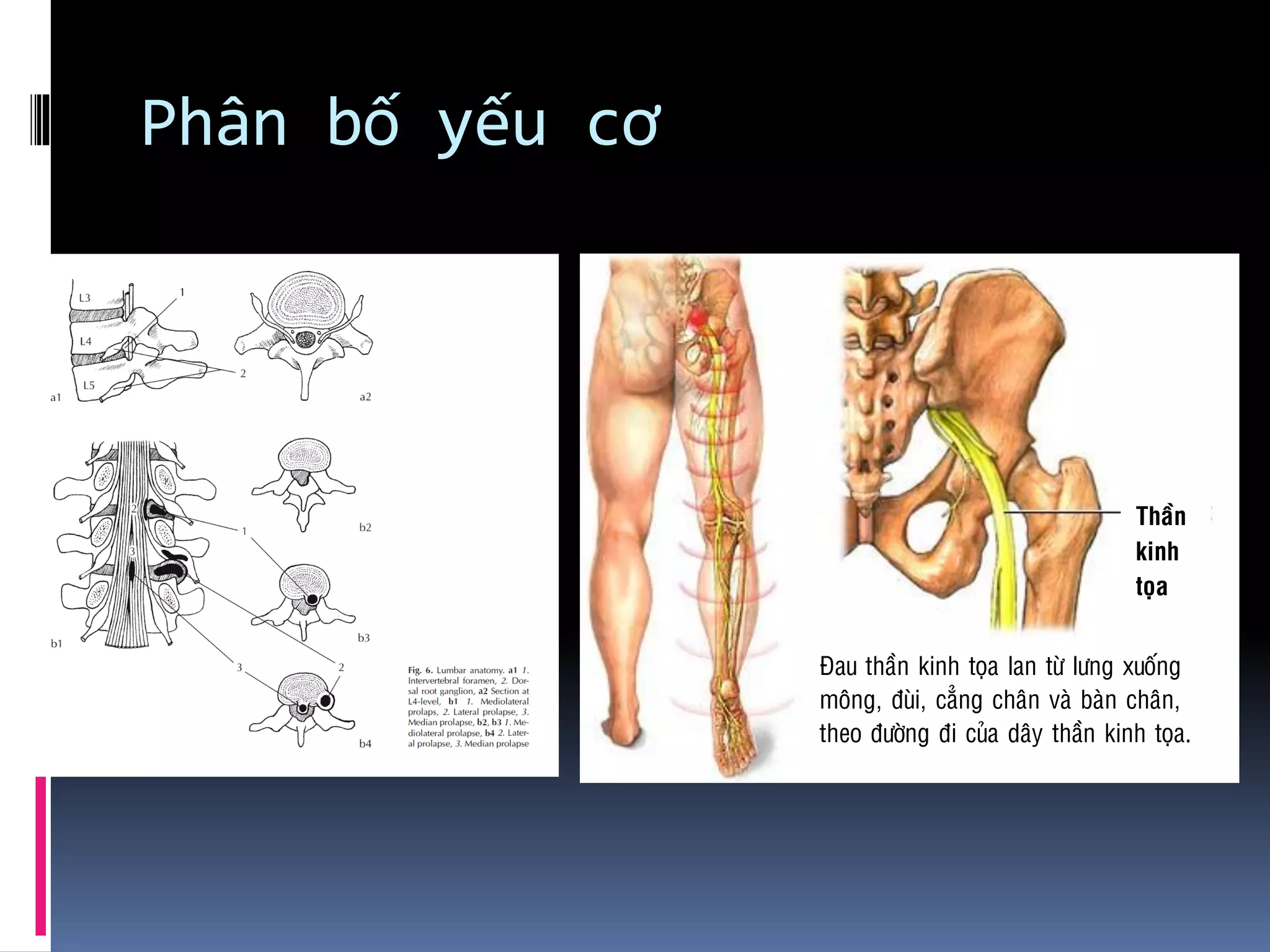 Phân bố yếu cơ
Ñau thaàn kinh toïa lan töø löng xuoáng
moâng, ñuøi, caúng chaân vaø baøn chaân,
theo ñöôøng ñi cuûa daây thaàn kinh toïa.
Thaàn
kinh
toïa
 
