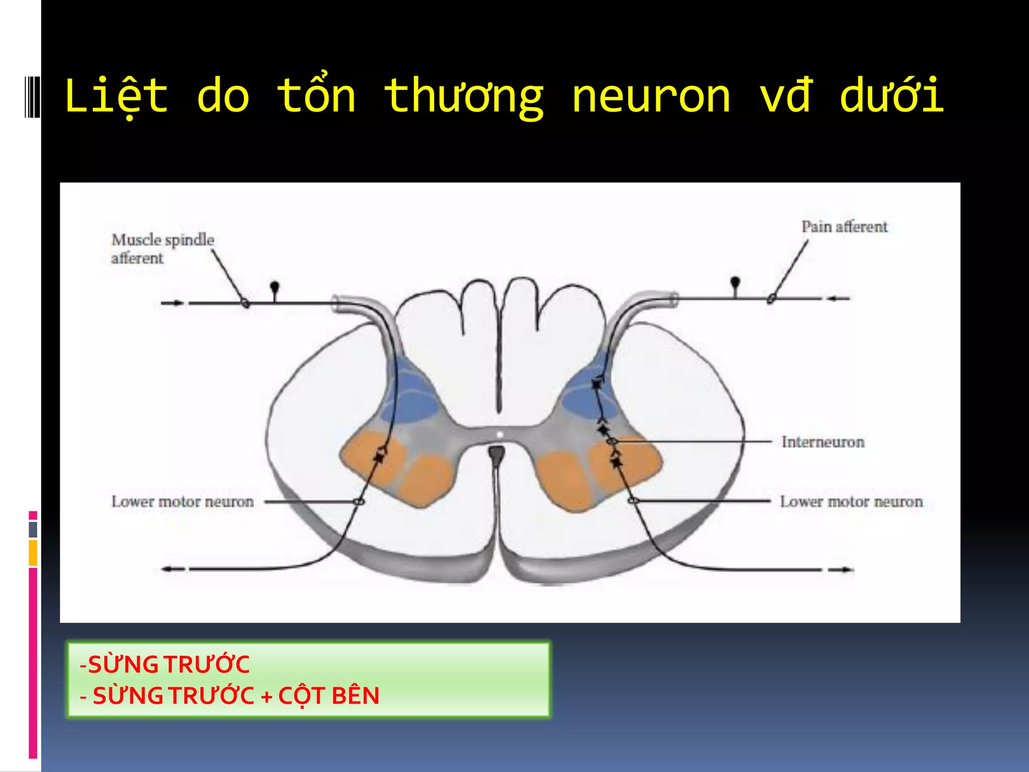 Liệt do tổn thương neuron vđ dưới
-SỪNGTRƯỚC
- SỪNGTRƯỚC + CỘT BÊN
 