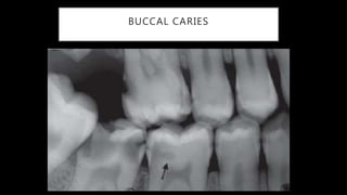 Radiographic Interpretation of Dental Caries | PPTX