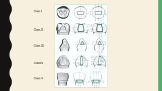 Class I
Class II
Class III
ClassIV
Class V
 