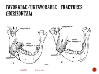 3. mandible fractures