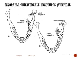 3. mandible fractures
