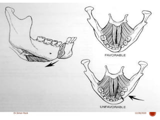 3. mandible fractures