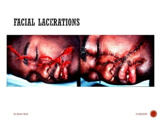 3. mandible fractures