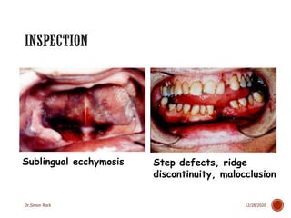 3. mandible fractures