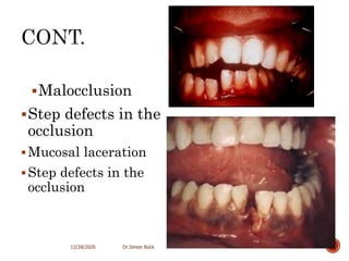 3. mandible fractures