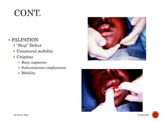 3. mandible fractures