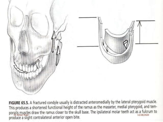 3. mandible fractures