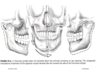 3. mandible fractures
