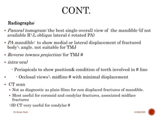 3. mandible fractures