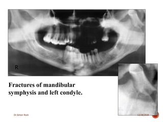 3. mandible fractures