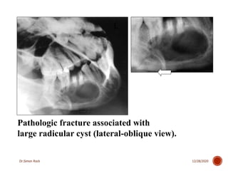 3. mandible fractures