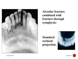 3. mandible fractures