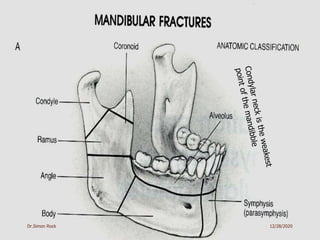 3. mandible fractures