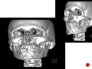 3. mandible fractures