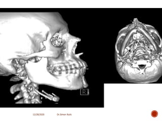 3. mandible fractures