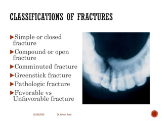 3. mandible fractures