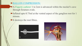 BALLON COMPRESSION:
A Fogarty catheter 1 to 2cm is advanced within the meckel’s cave
through foramen ovale.
Inflated upto 0.75ml at the ventral aspect of the ganglion root for 1
minute.
It destroys the root fibres.
 