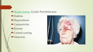 Ocular lesions: Eyelid: Periorbital pain
Oedema
Hyperasthesia
Conjunctivitis
Scleritis
Corneal scarring
Glaucoma
 