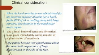 Clinical consideration
When the local anesthesia was administered for
the posterior superior alveolar nerve block,
forthe RCT of 16, a swelling along with large
extraoral discoloration in the mandibular
lower region.
and a small intraoral hematoma formation
takes place immediately within minutes of
administration of anesthesia.
The patient became very apprehensive about
the unaesthetic appearance of large
discoloration on the side of the face.
 