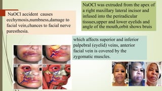 NaOCl accident causes
ecchymosis,numbness,damage to
facial vein,chances to facial nerve
paresthesia.
NaOCl was extruded from the apex of
a right maxillary lateral incisor and
infused into the periradicular
tissues,upper and lower eyelids and
angle of the mouth,orbit shows bruis
which affects superior and inferior
palpebral (eyelid) veins, anterior
facial vein is covered by the
zygomatic muscles.
 