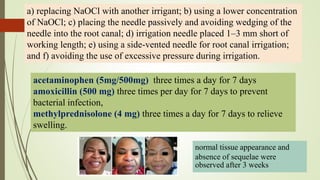 a) replacing NaOCl with another irrigant; b) using a lower concentration
of NaOCl; c) placing the needle passively and avoiding wedging of the
needle into the root canal; d) irrigation needle placed 1–3 mm short of
working length; e) using a side-vented needle for root canal irrigation;
and f) avoiding the use of excessive pressure during irrigation.
acetaminophen (5mg/500mg) three times a day for 7 days
amoxicillin (500 mg) three times per day for 7 days to prevent
bacterial infection,
methylprednisolone (4 mg) three times a day for 7 days to relieve
swelling.
normal tissue appearance and
absence of sequelae were
observed after 3 weeks
 