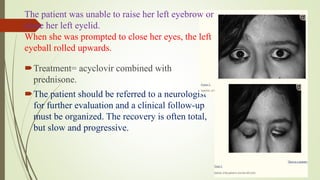 Treatment= acyclovir combined with
prednisone.
The patient should be referred to a neurologist
for further evaluation and a clinical follow-up
must be organized. The recovery is often total,
but slow and progressive.
The patient was unable to raise her left eyebrow or
close her left eyelid.
When she was prompted to close her eyes, the left
eyeball rolled upwards.
 