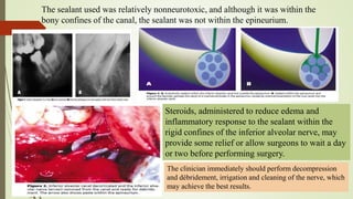 The sealant used was relatively nonneurotoxic, and although it was within the
bony confines of the canal, the sealant was not within the epineurium.
Steroids, administered to reduce edema and
inflammatory response to the sealant within the
rigid confines of the inferior alveolar nerve, may
provide some relief or allow surgeons to wait a day
or two before performing surgery.
The clinician immediately should perform decompression
and débridement, irrigation and cleaning of the nerve, which
may achieve the best results.
 