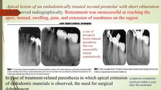 Apical lesion of an endodontically treated second premolar with short obturation
was observed radiographically. Retreatment was unsuccessful at reaching the
apex; instead, swelling, pain, and extension of numbness on the region
In case of treatment-related paresthesia in which apical extrusion
of endodontic materials is observed, the need for surgical
a case of
periapical
lesion-induced
paresthesia
that was
successfully
treated
endodontically
symptoms completely
resolved within a year
after the treatment
 