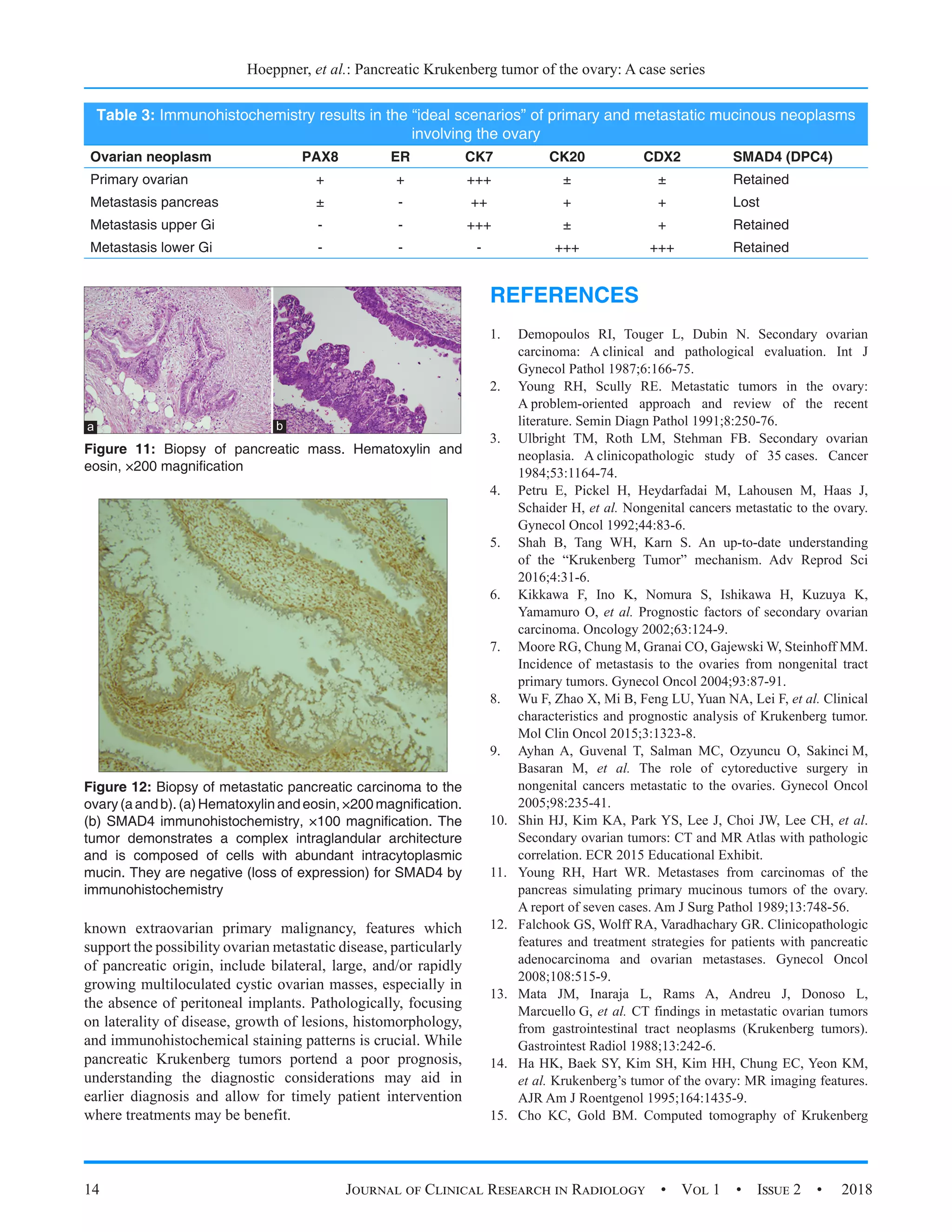 Pancreatic Krukenberg Tumor of the Ovary: A Case Series | PDF