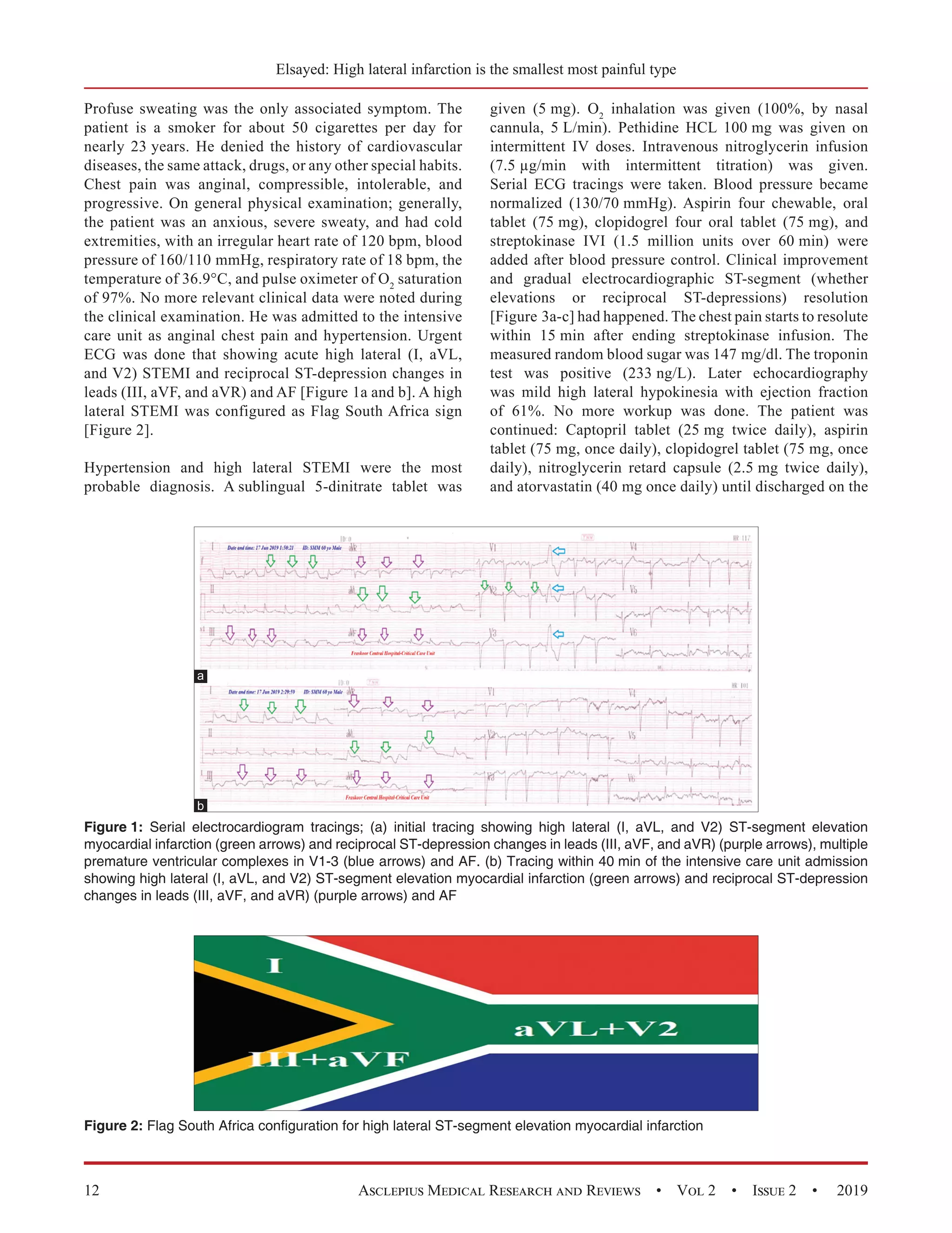 High Lateral Myocardial Infarction; the Smallest but the Most Painful ...