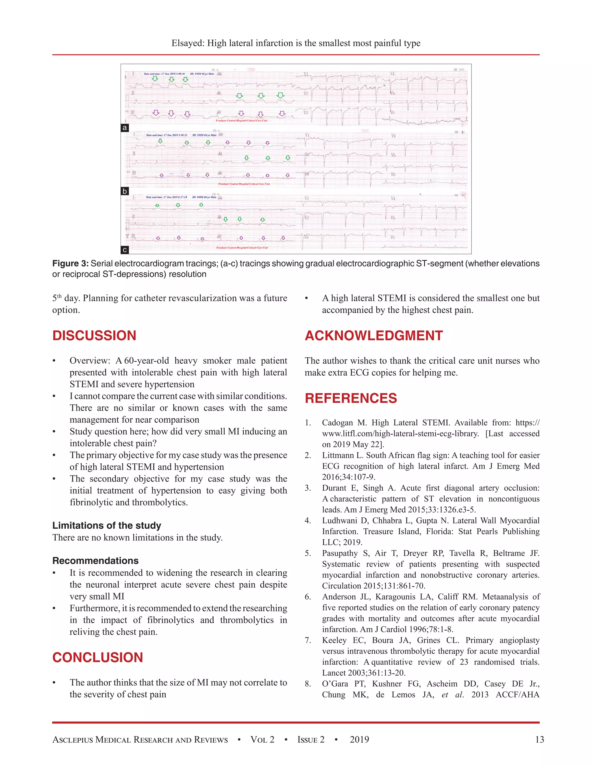 High Lateral Myocardial Infarction; the Smallest but the Most Painful ...