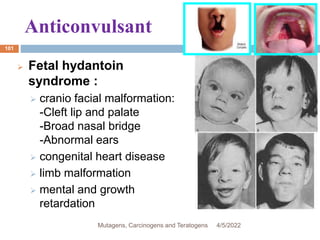 Anticonvulsant
101
 Fetal hydantoin
syndrome :
 cranio facial malformation:
-Cleft lip and palate
-Broad nasal bridge
-Abnormal ears
 congenital heart disease
 limb malformation
 mental and growth
retardation
4/5/2022
Mutagens, Carcinogens and Teratogens
 